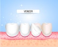 Veneers in dental orthopedics and aesthetic medicine. Lumineers, overlays, micro-prosthetics. Installation of veneers.